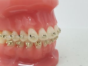 złoty aparat ortodontyczny szczecin
